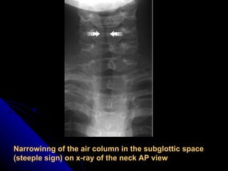 Narrowinng of the air column in the subglottic space (steeple sign) on x-ray of the neck AP view 