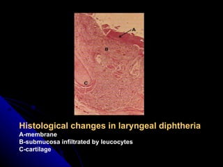 Histological changes in laryngeal diphtheria A-membrane B-submucosa infiltrated by leucocytes C-cartilage 