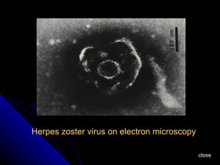 Herpes zoster virus on electron microscopy close 