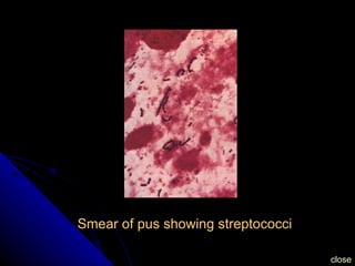 Smear of pus showing streptococci close 