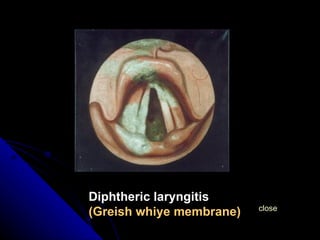 close Diphtheric laryngitis (Greish whiye membrane) 