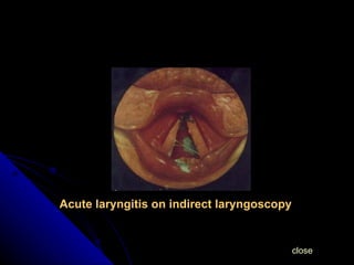 Acute laryngitis on indirect laryngoscopy close 