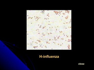 H-influenza close 