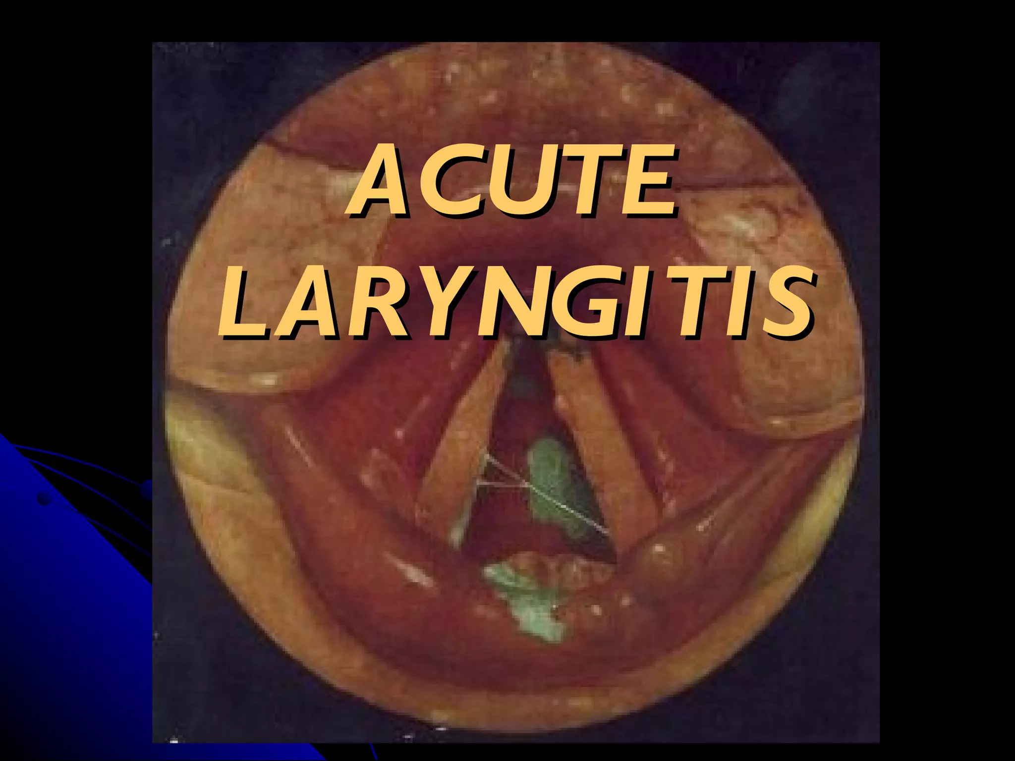 E.N.T.Acute laryngitis.(dr.usif chalabe) | PPT