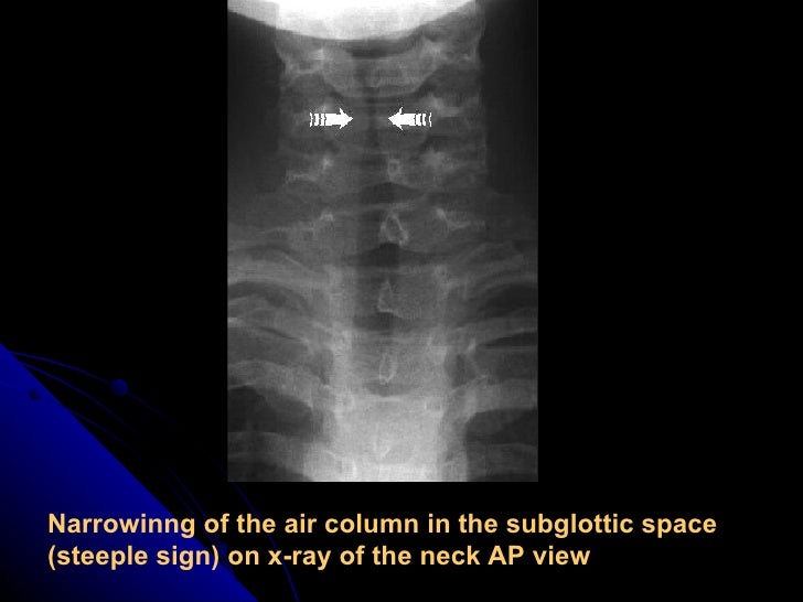 Which Condition Causes A Steeple Sign On X-ray? E.N.T.Acute laryngitis.(dr.usif chalabe)