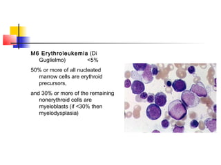 M6 Erythroleukemia (Di 
Guglielmo) <5% 
50% or more of all nucleated 
marrow cells are erythroid 
precursors, 
and 30% or more of the remaining 
nonerythroid cells are 
myeloblasts (if <30% then 
myelodysplasia) 
 