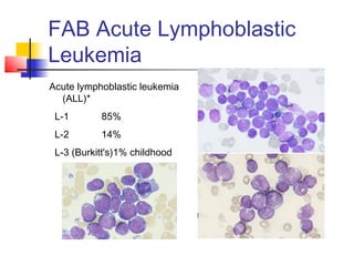 FAB Acute Lymphoblastic 
Leukemia 
Acute lymphoblastic leukemia 
(ALL)* 
L-1 85% 
L-2 14% 
L-3 (Burkitt's)1% childhood 
 