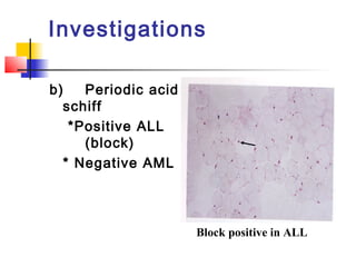Investigations 
b) Periodic acid 
schiff 
*Positive ALL 
(block) 
* Negative AML 
Block positive in ALL 
 