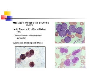 M5a Acute Monoblastic Leukemia 
10-15% 
M5b AMoL with differentiation 
<5% 
Often asso with infiltration into 
gums/skin 
Weakness, bleeding and diffuse 
erythematous skin rash 
 