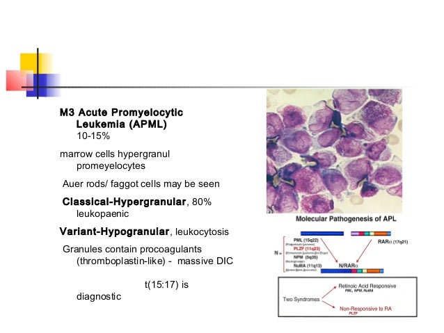 Acute leukaemia