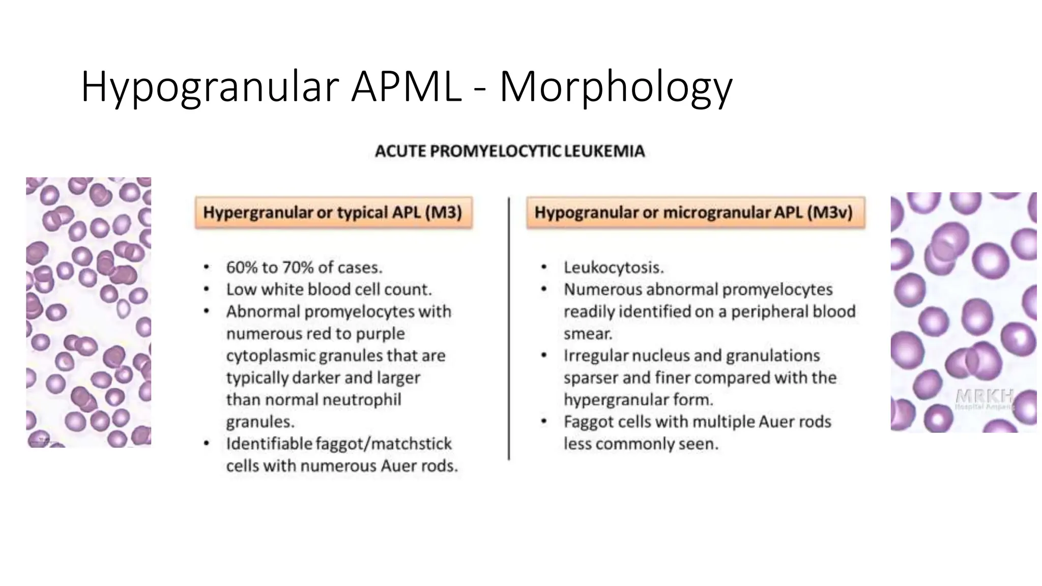Lococo Apml Acute Leukaemia - Most common leukaemia in adults | PPTX