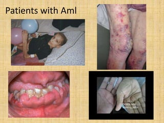 Patients with Aml

 