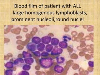 Blood film of patient with ALL
large homogenous lymphoblasts,
prominent nucleoli,round nuclei

 