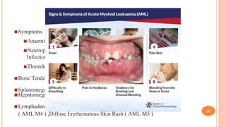 acute leukemia.pptx pathogenesis genetics | PPTX