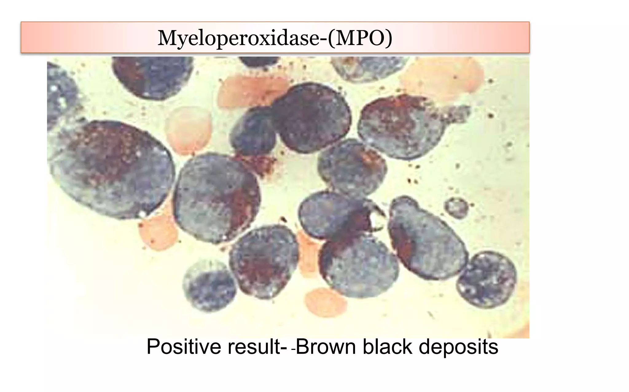 Myeloperoxidase-(MPO)
Positive result- Brown black deposits
 