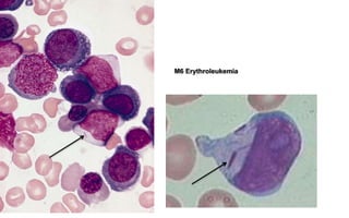 M6 Erythroleukemia
 