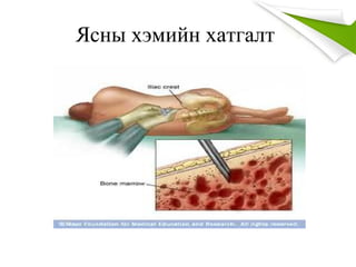 Ясны хэмийн хатгалт
 