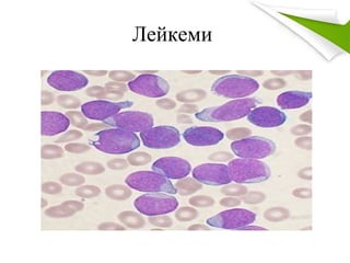 Лейкеми
 