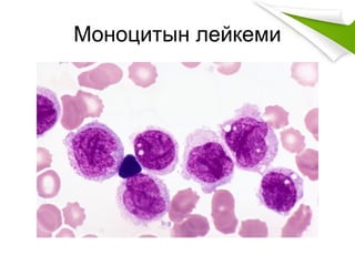 Моноцитын лейкеми
 