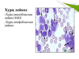 Хурц лейкоз
-Хурц миелобластын
лейкоз ХМЛ
-Хурц лимфобластын
лейкоз
 