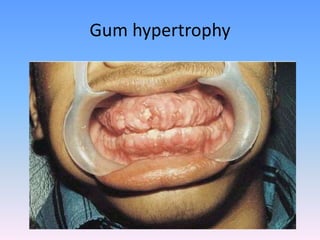 Gum hypertrophy
 