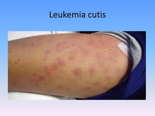 Leukemia cutis
 