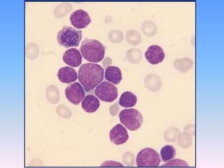 Acute Lymphoid Leukemia
WHO classification
- WHO classification considers ALL and lymphblastic
lymphoma to be single disea...