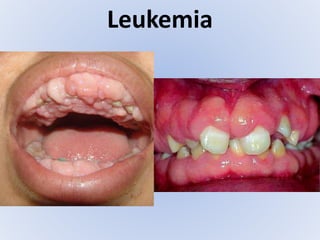 Leukemia
 