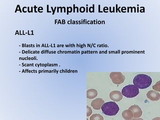 Acute Lymphoid Leukemia
- Blasts in ALL-L1 are with high N/C ratio.
- Delicate diffuse chromatin pattern and small prominent
nucleoli.
- Scant cytoplasm .
- Affects primarily children
FAB classification
ALL-L1
 