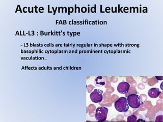 Acute Lymphoid Leukemia
FAB classification
ALL-L3 : Burkitt's type
- L3 blasts cells are fairly regular in shape with strong
basophilic cytoplasm and prominent cytoplasmic
vaculation .
Affects adults and children
 