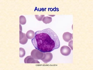 Acute leukemias 1-csbrp | PPT