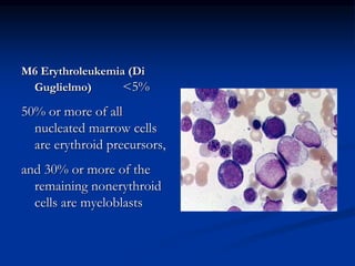 M6 Erythroleukemia (Di
Guglielmo) <5%
50% or more of all
nucleated marrow cells
are erythroid precursors,
and 30% or more of the
remaining nonerythroid
cells are myeloblasts
 