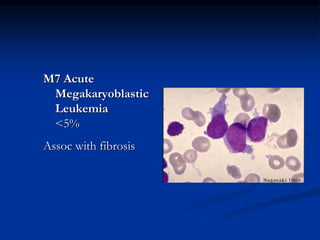 M7 Acute
Megakaryoblastic
Leukemia
<5%
Assoc with fibrosis
 