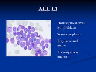 ALL L1
Homogenous small
lymphoblasts
Scant cytoplasm
Regular round
nuclei
Inconspicuous
nucleoli
 