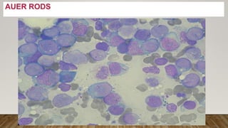 Acute Leukemias by Dr. Sookun Rajeev Kumar | PPTX