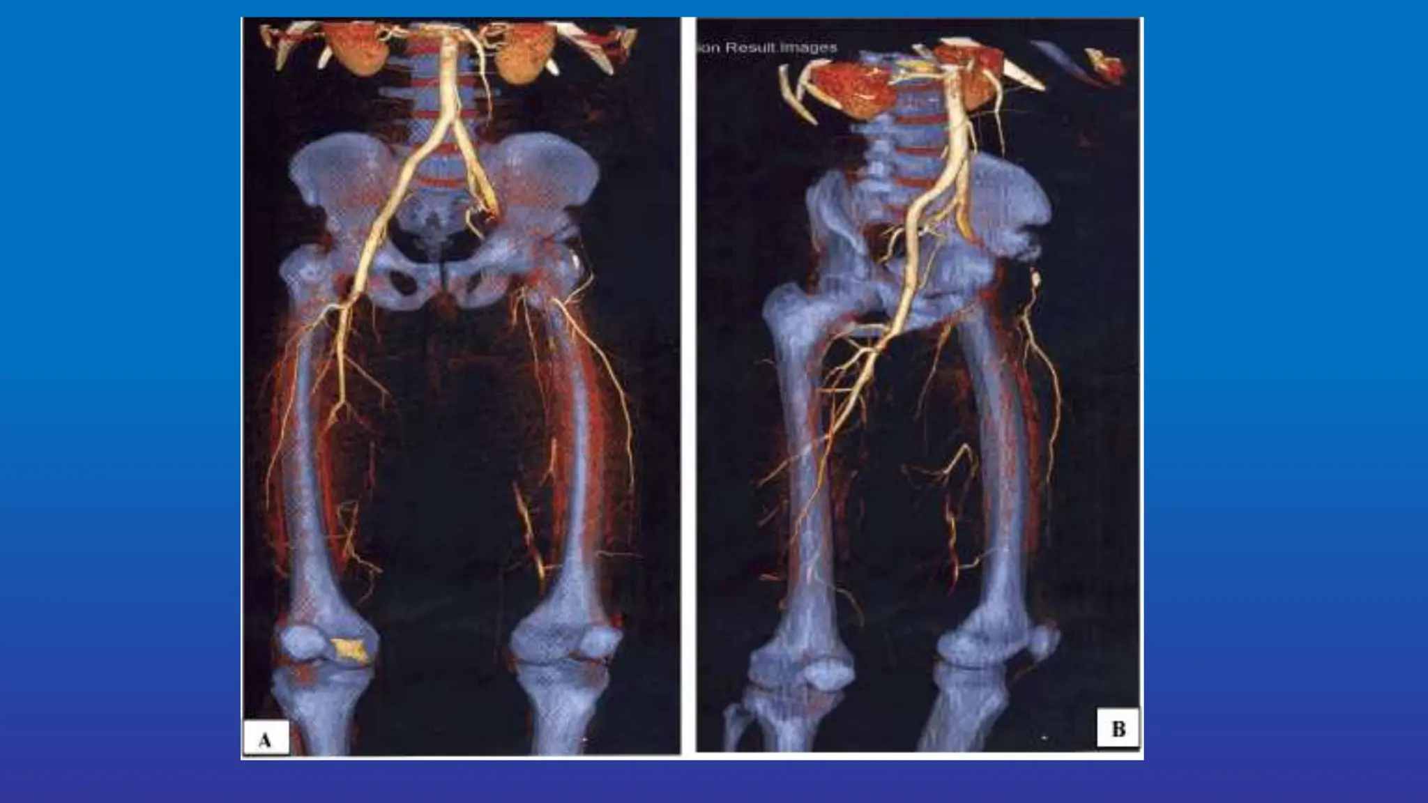 Diagnosis and management of Acute limb -ischemia (1).ppt