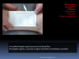 What are we
looking for?
NORMAL
• Multiphasic
• Pulsatile
• Regular amplitude
An audible Doppler signal assures some blood flow
No Doppler signals, a vascular surgeon should be immediately consulted
sumeryadav2004@gmail.com
 