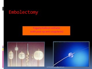 Embolectomy
Fogarty balloon catheter
(with post-op anti coagulants)
sumeryadav2004@gmail.com
 