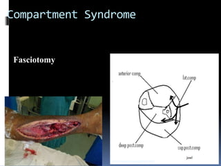 Compartment Syndrome
Fasciotomy
sumeryadav2004@gmail.com
 