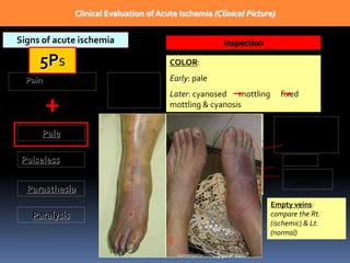Clinical Evaluation of Acute Ischemia (Clinical Picture)
Signs of acute ischemia
5Ps
Pain: symptom
+
Pulseless
Pale
Parasthesia
Paralysis
Inspection
COLOR:
Early: pale
Later: cyanosed mottling fixed
mottling & cyanosis
Pallor
Reversible
mottling
An area of fixed
cyanosis
surrounded by
reversible mottling
Empty veins:
compare the Rt.
(ischemic) & Lt.
(normal)
Fixed
mottling &
cyanosis
sumeryadav2004@gmail.com
 