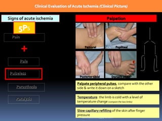Clinical Evaluation of Acute Ischemia (Clinical Picture)
Signs of acute ischemia
5Ps
Pain: symptom
+
Pulseless
Pale
Parasthesia
Paralysis
Palpation
Femoral Popliteal
Posterior tibial Dorsalis pedis
Palpate peripheral pulses, compare with the other
side & write it down on a sketch
Temperature: the limb is cold with a level of
temperature change (compare the two limbs)
Slow capillary refilling of the skin after finger
pressure
sumeryadav2004@gmail.com
 