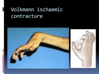 Volkmann ischaemic
contracture
 