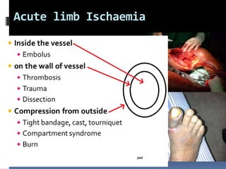 Acute limb Ischaemia
 