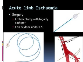 Acute limb Ischaemia
 Surgery
 Embolectomy with fogarty
catheter
 Can be done under LA
 