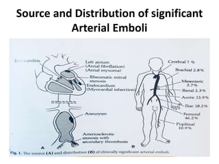 Source and Distribution of significant
Arterial Emboli
 