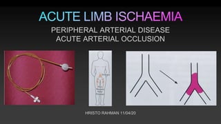 HRISTO RAHMAN 11/04/20
PERIPHERAL ARTERIAL DISEASE
ACUTE ARTERIAL OCCLUSION
 