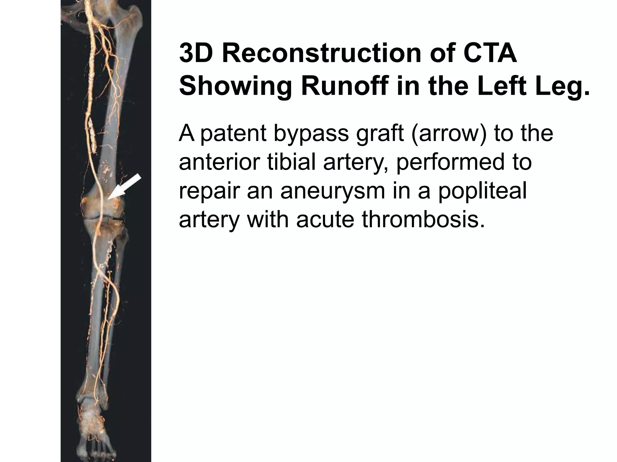 3D Reconstruction of CTA
Showing Runoff in the Left Leg.
A patent bypass graft (arrow) to the
anterior tibial artery, performed to
repair an aneurysm in a popliteal
artery with acute thrombosis.
 