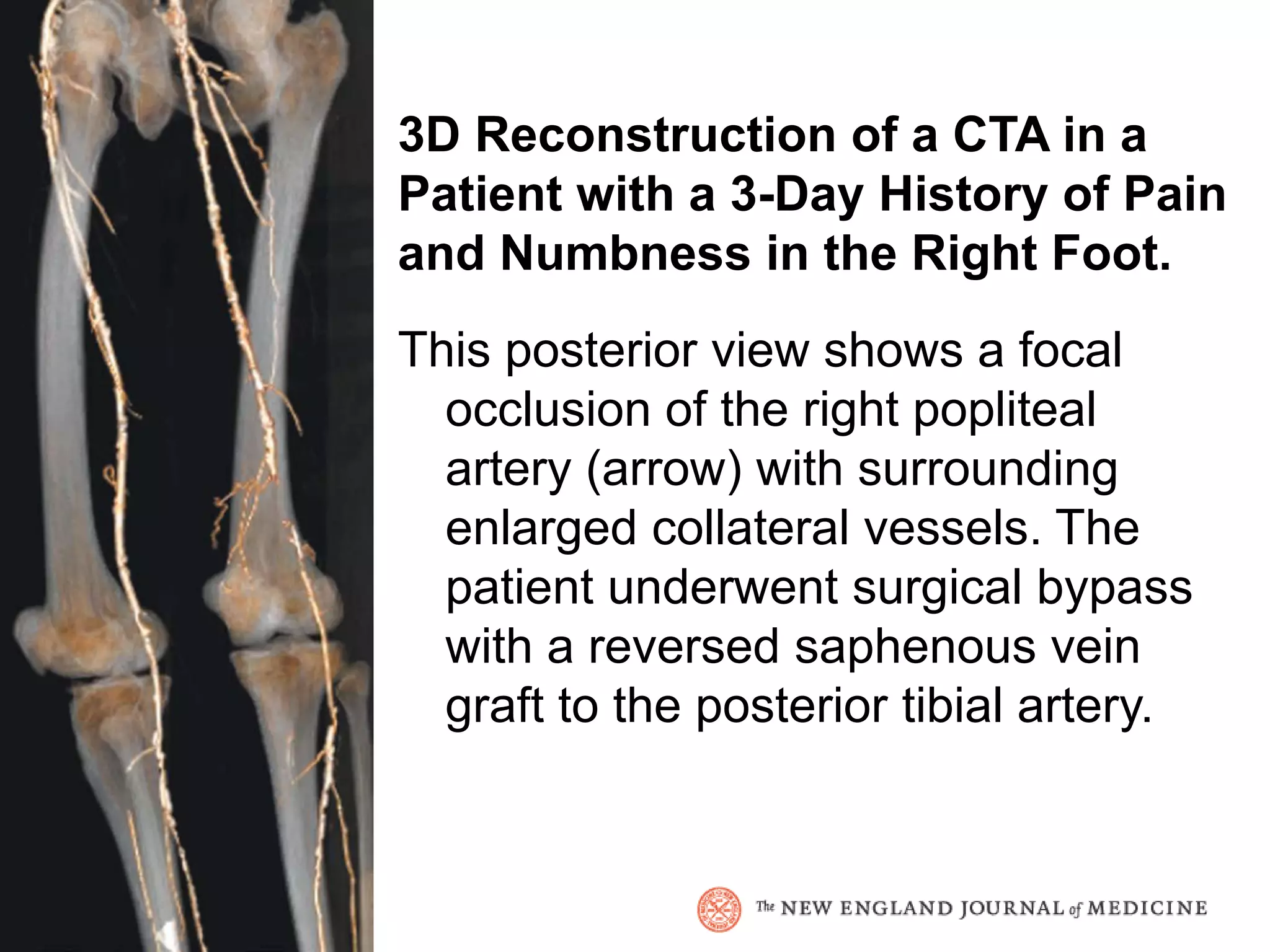 3D Reconstruction of a CTA in a
Patient with a 3-Day History of Pain
and Numbness in the Right Foot.
This posterior view shows a focal
  occlusion of the right popliteal
  artery (arrow) with surrounding
  enlarged collateral vessels. The
  patient underwent surgical bypass
  with a reversed saphenous vein
  graft to the posterior tibial artery.
 