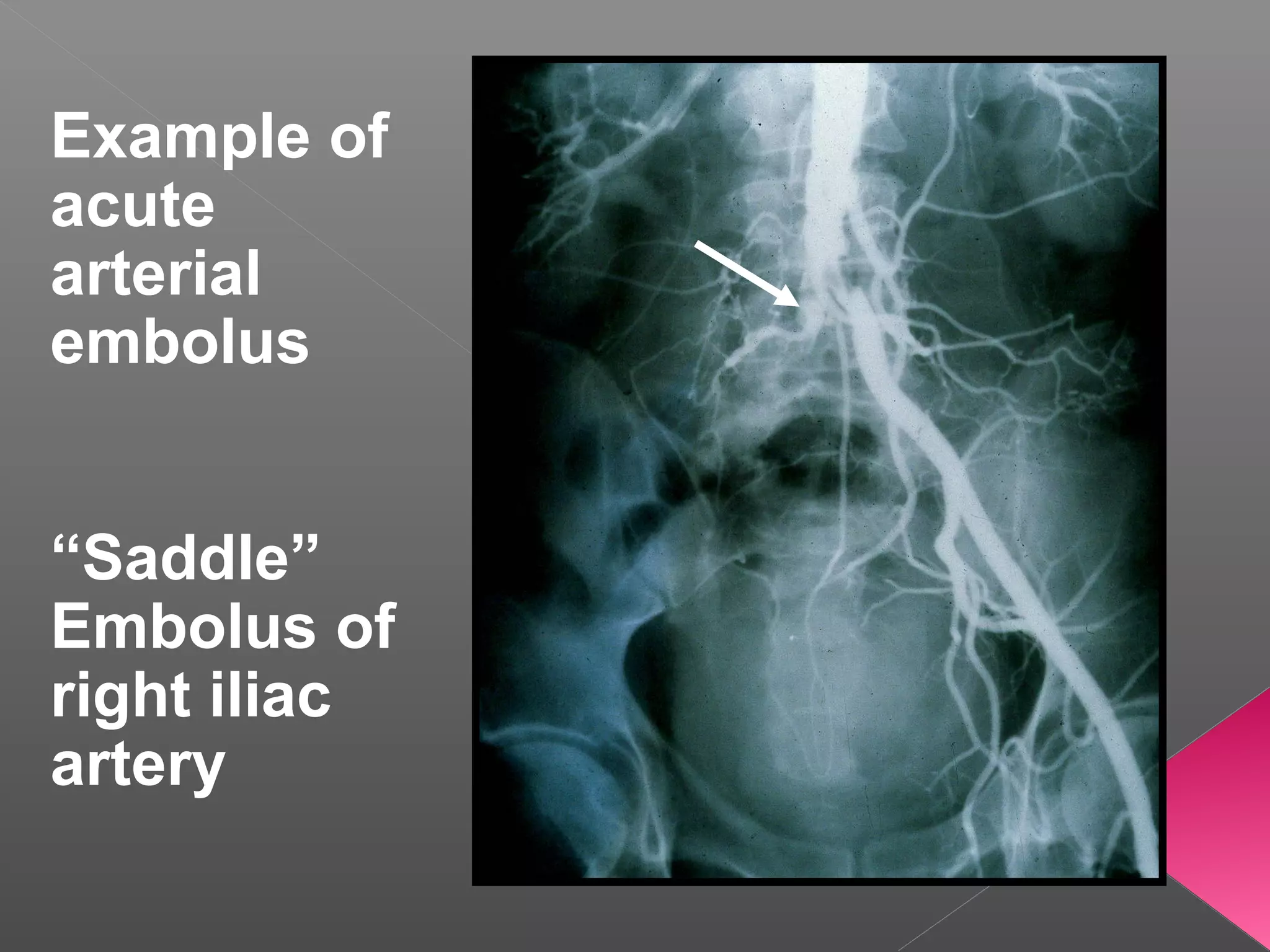 Acute limb ischemia | PPT