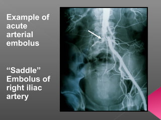 Example of
acute
arterial
embolus


“Saddle”
Embolus of
right iliac
artery
 